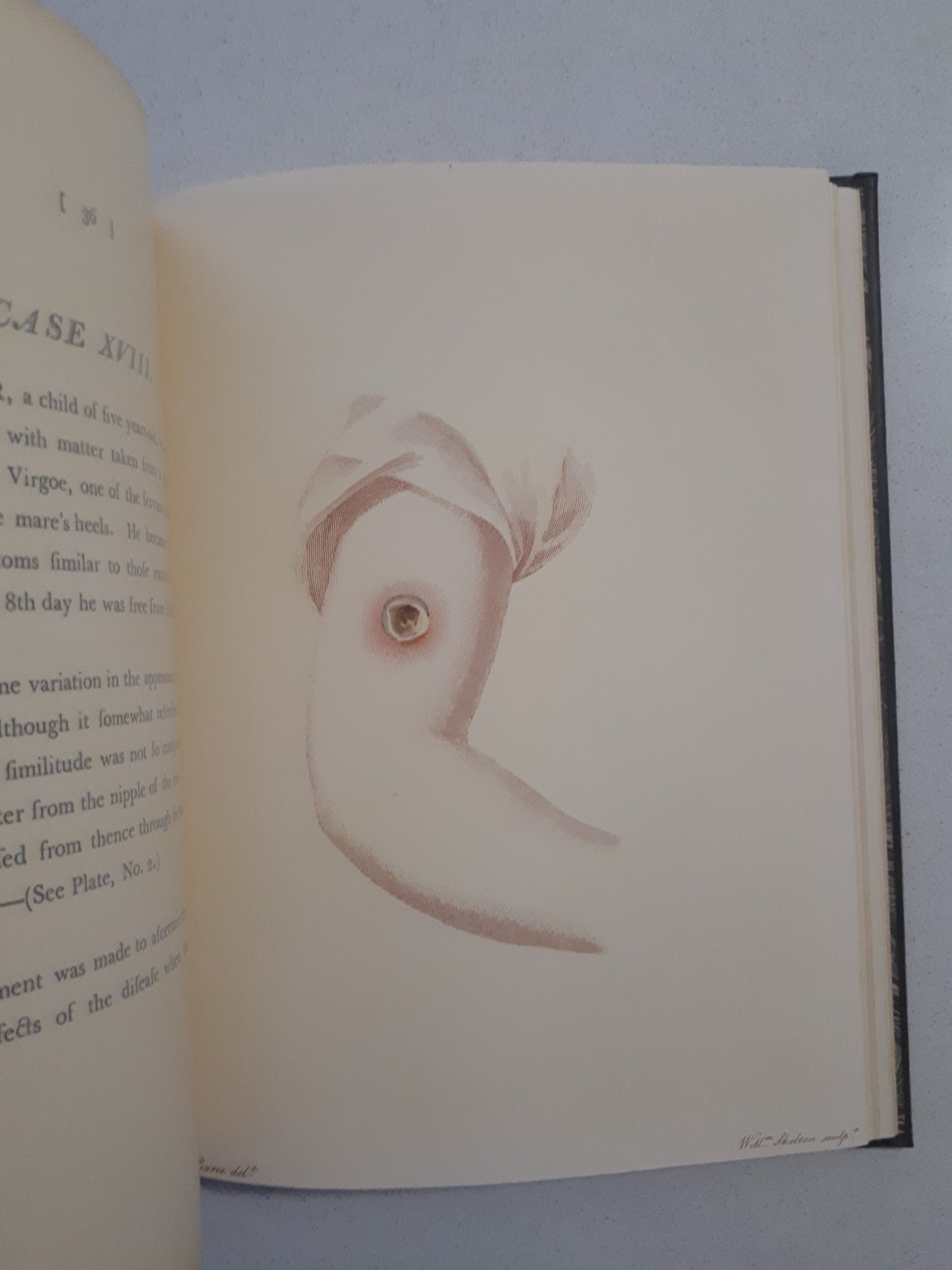 An Inquiry into The Causes and Effects of The Variolae Vaccinae by Edward Jenner